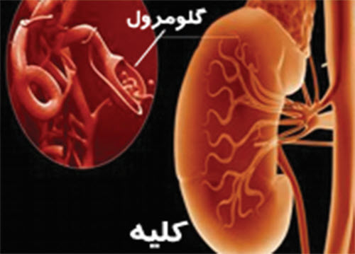 سندروم نفروتيك